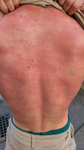 Allergie gegen Bienengift, Nesselausschlag