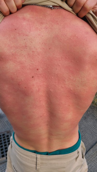 Allergie gegen Bienengift, Nesselausschlag